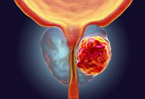 Quan hệ tình dục đều đặn giúp giảm nguy cơ bị ung thư tuyến tiền liệt