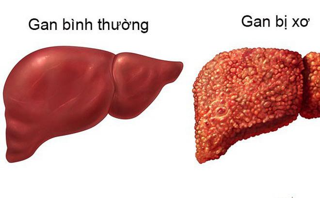 5 nguyên nhân gây xơ gan hàng đầu ở nước ta