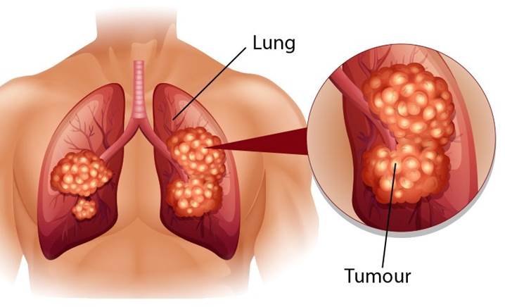 Bệnh viêm phế quản mãn tính nghề nghiệp có nguy hiểm không