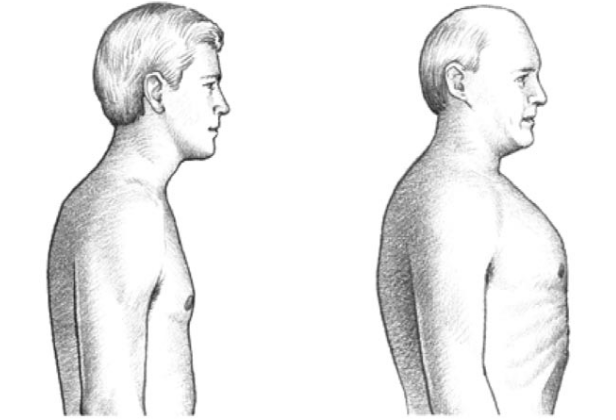 Lồng ngực bình thường và lồng ngực hình thùng của bệnh nhân COPD