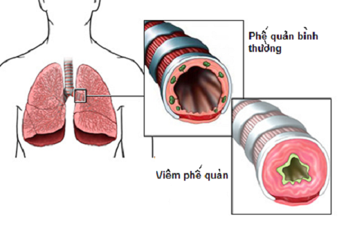 Phế quản bị sưng và viêm, khiến đường thở bị hẹp