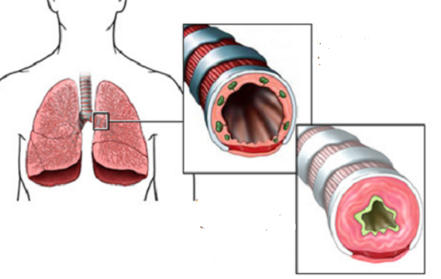 Phế quản bình thường và phế quản bị viêm, xơ hóa