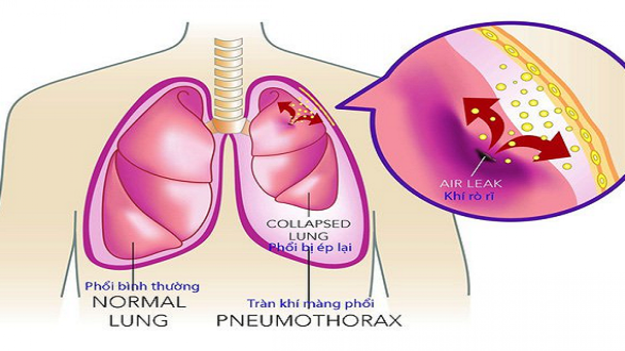 Tràn khí màng phổi là một biến chứng nguy hiểm.