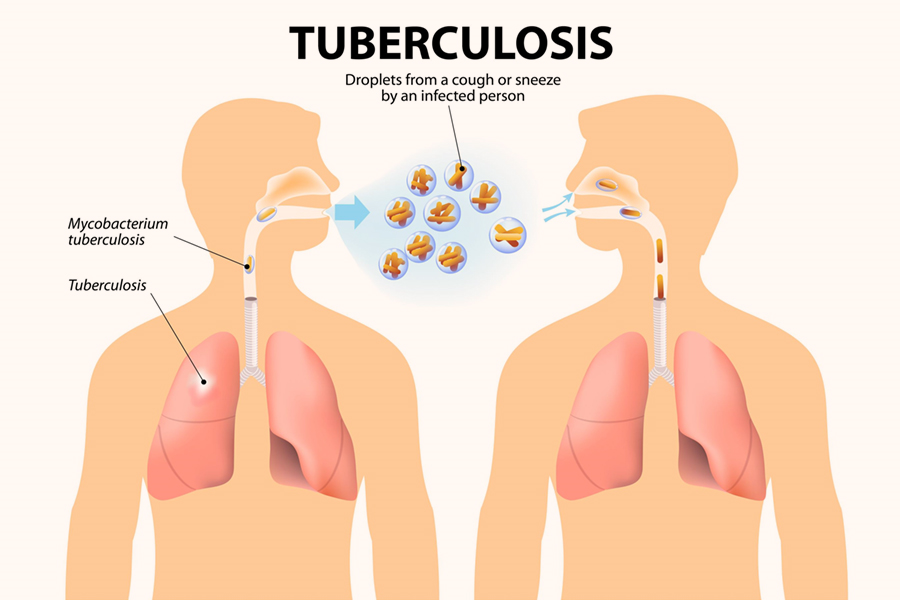 Tiếp xúc với bệnh nhân lao phổi, người bệnh dễ bị lao tái phát