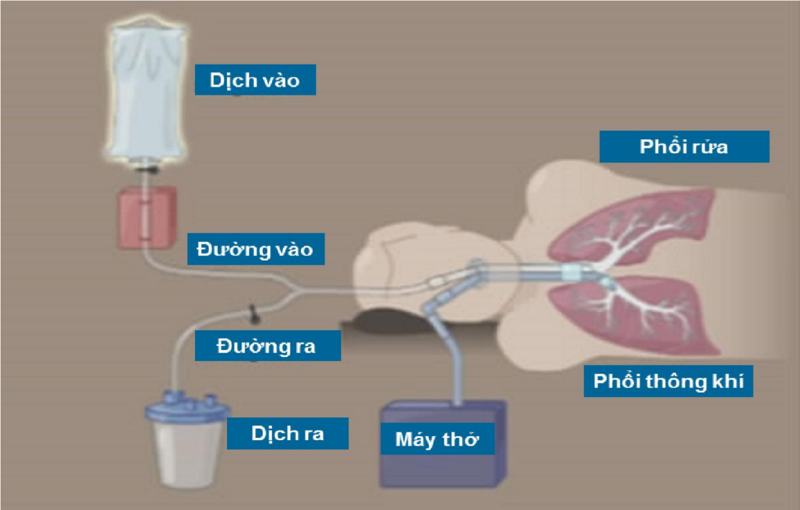 Phương pháp rửa phổi cho người bị bệnh bụi phổi nghề nghiệp