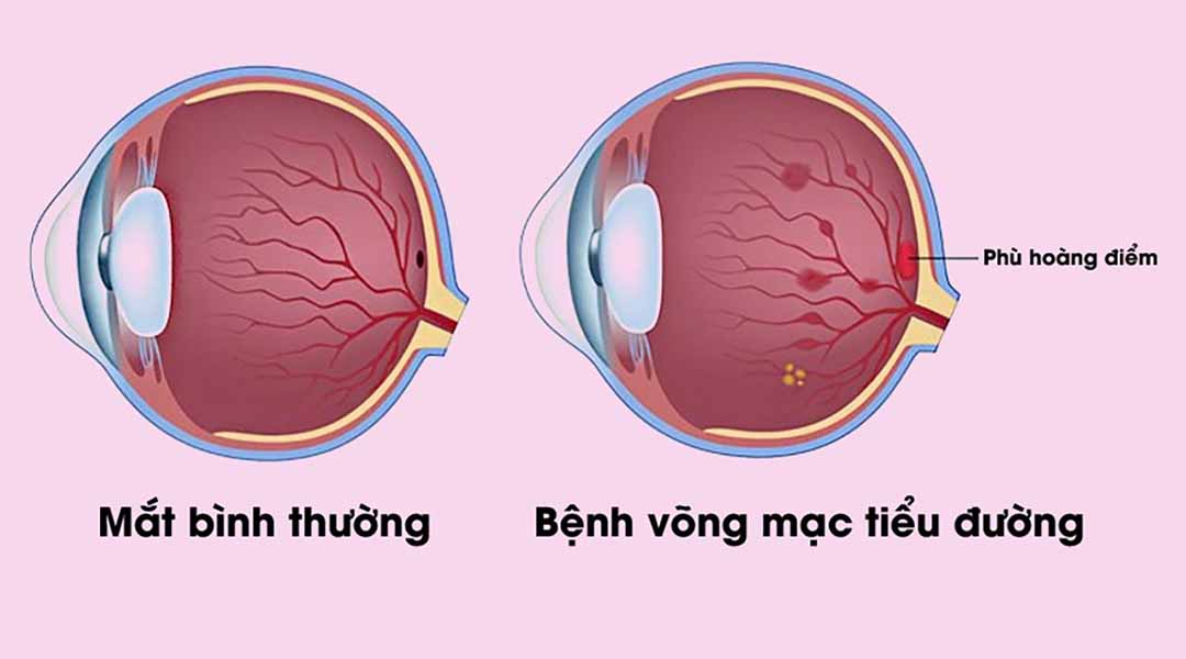 Bệnh tiểu đường gây biến chứng trên mắt