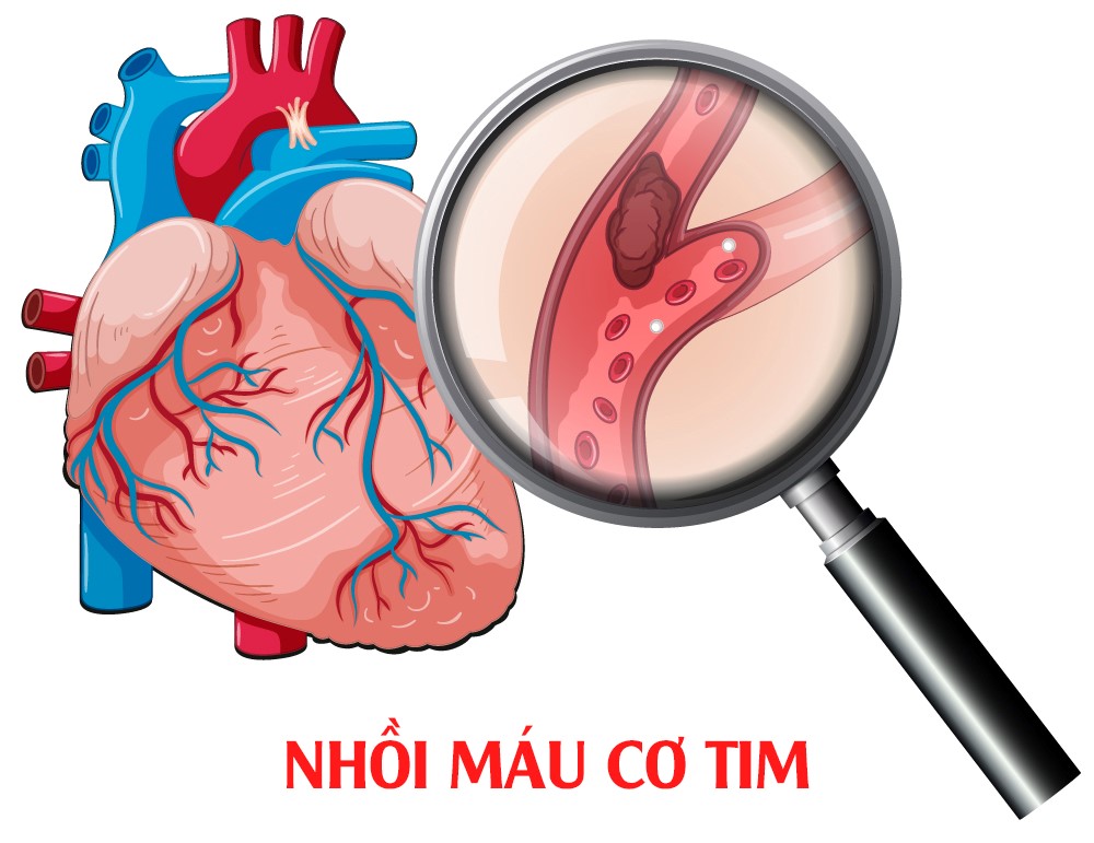 Nhồi máu cơ tim là một biến chứng nguy hiểm của bệnh tiểu đường