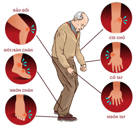 Bệnh Gút có chữa khỏi được không?