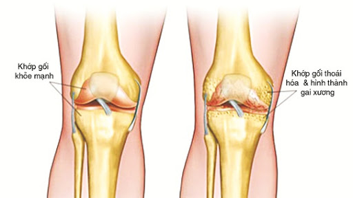 Bệnh gút ở đầu gối dễ bị chẩn đoán nhầm thành thoái hóa khớp