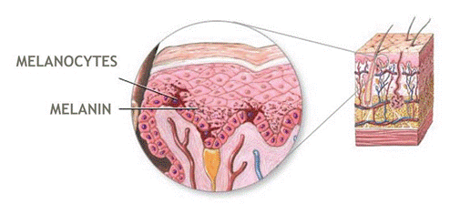 Tóc bạc do sự suy giảm sắc tố melanin