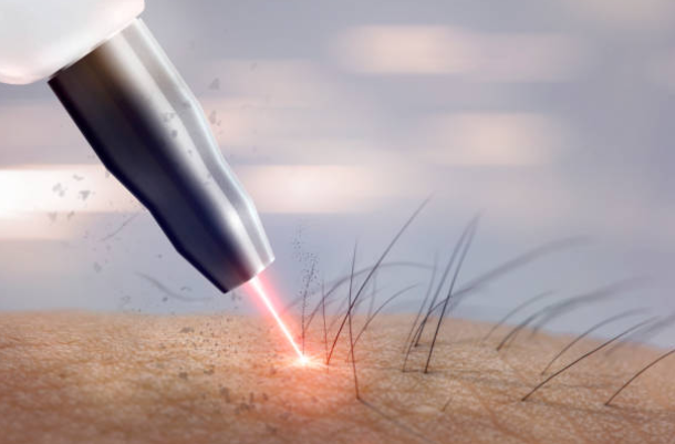  Liệu pháp laser cường độ thấp điều trị hói đầu ở nam giới