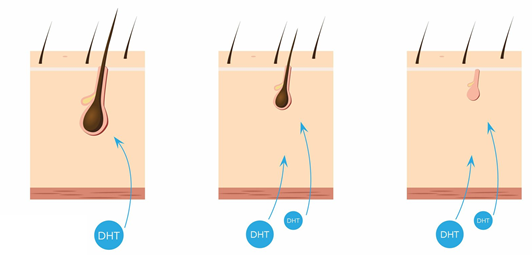 DHT là nguyên nhân phổ biến gây rụng tóc
