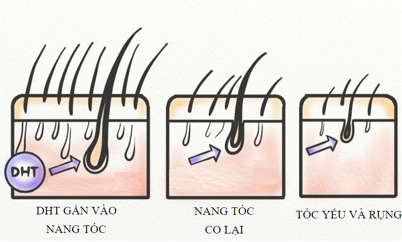 DHT là nguyên nhân khiến tóc rụng nhiều không thể không nhắc đến