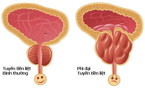 Phì đại tiền liệt tuyến gây chèn ép vào niệu đạo