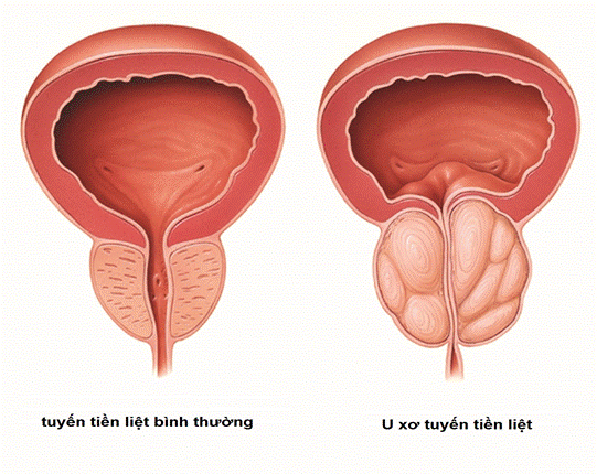 U xơ tiền liệt tuyến