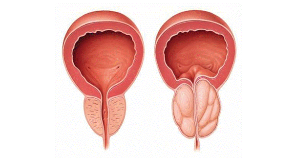 U xơ tuyến tiền liệt