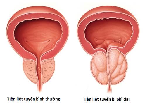 Bệnh lý u xơ tiền liệt tuyến