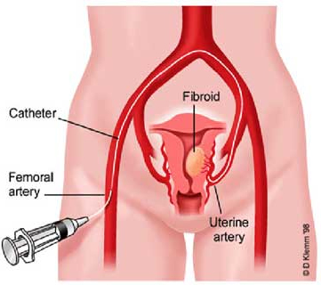 Quy trình thực hiện nút mạch điều trị u xơ tuyến tiền liệt