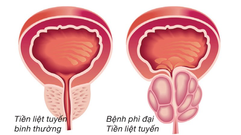 Tiểu rắt có thể là dấu hiệu bệnh phì đại tuyến tiền liệt