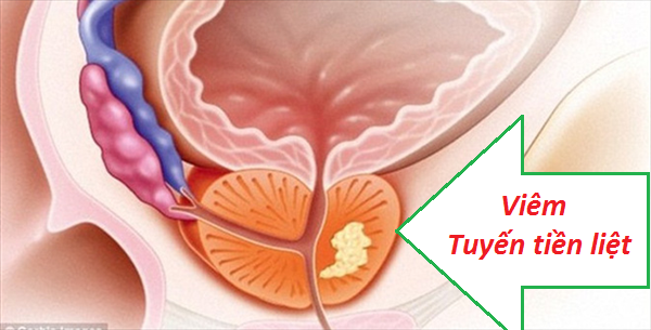 Bệnh viêm tuyến tiền liệt ở nam giới