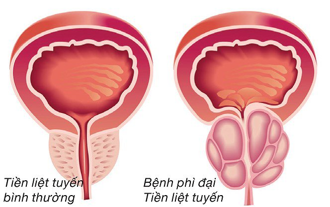 Sự tăng sinh enzym 5α-reductase là nguyên nhân khiến nam giới trung và cao niên dễ bị u xơ tuyến tiền liệt