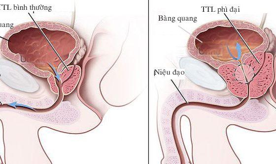 Tuyến tiền liệt bị phì đại gây hẹp niệu đạo.