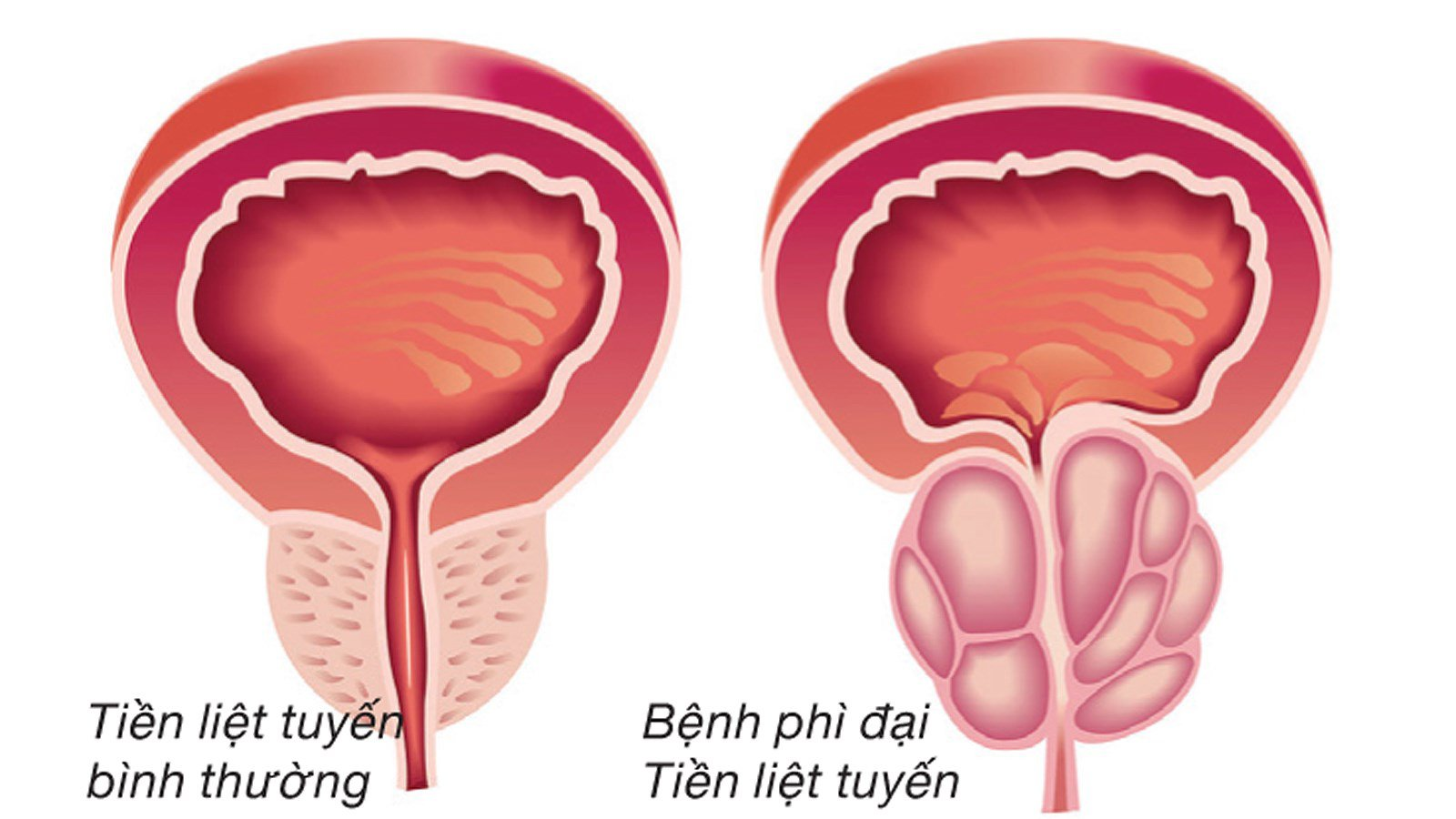 Phì đại tuyến tiền liệt có nguy hiểm không? Giải pháp khắc phục tối ưu là gì?