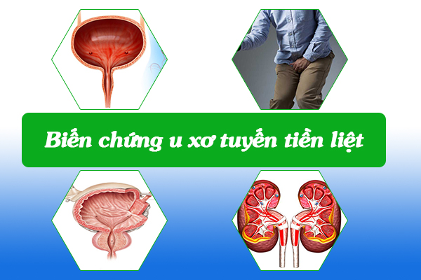 Biến chứng u xơ tuyến tiền liệt là gì?