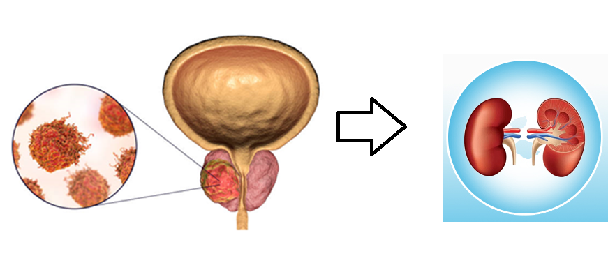 U xơ tuyến tiền liệt có thể gây biến chứng suy thận rất nguy hiểm