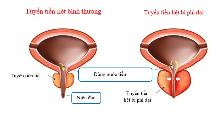  Phì đại tuyến tiền liệt là gì?