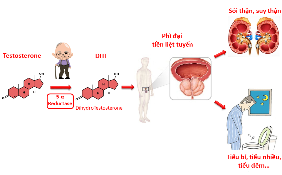 Sự tăng sinh DHT là nguyên nhân gây phì đại tuyến tiền liệt