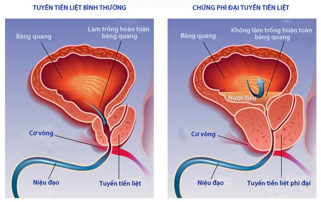 Phì đại tuyến tiền liệt là nguyên nhân hàng đầu gây ra tình trạng tiểu không hết ở nam giới