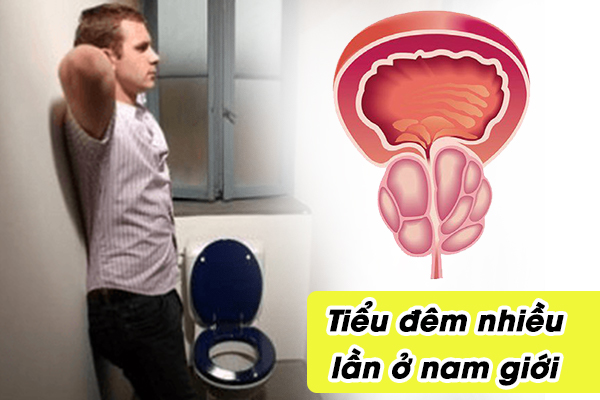 Phải làm sao để khắc phục tiểu đêm nhiều lần ở nam giới bị u xơ tuyến tiền liệt?