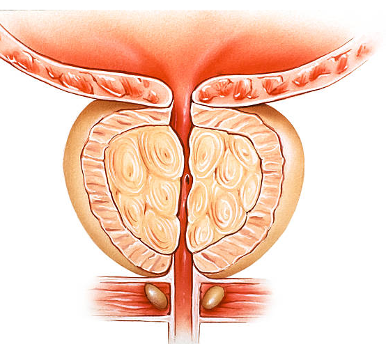 Cách phòng ngừa biến chứng phì đại tuyến tiền liệt đơn giản và hiệu quả