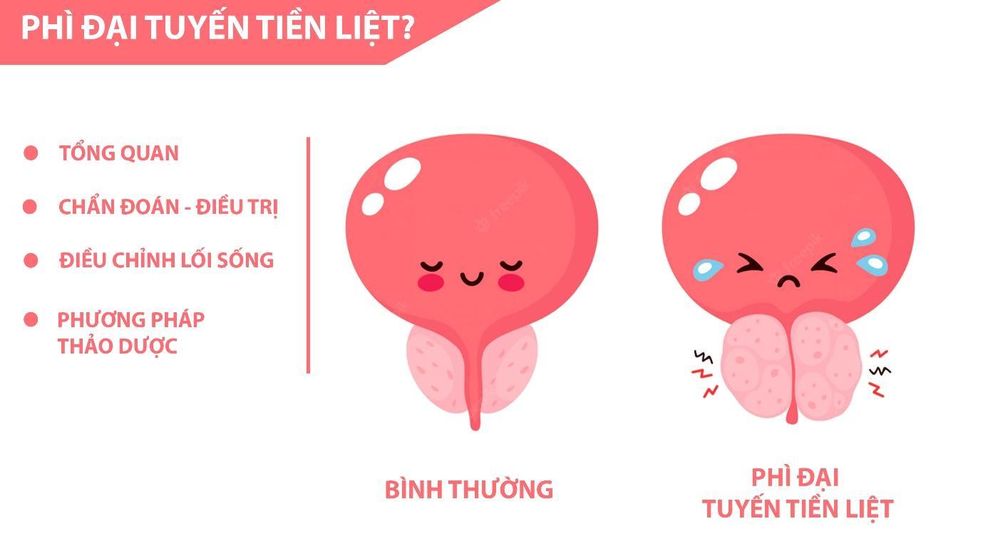 Phì đại tuyến tiền liệt