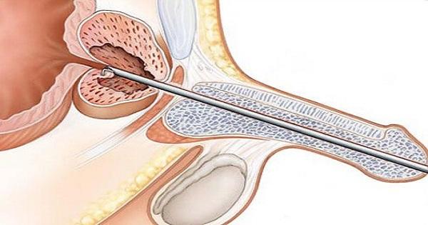 Giải pháp giúp giảm tái phát sau khi phẫu thuật cắt bỏ tuyến tiền liệt phì đại