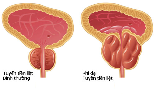 Phì đại tuyến tiền liệt là nguyên nhân thường gặp gây đau buốt khi đi tiểu ở nam giới ngoài 45 tuổi