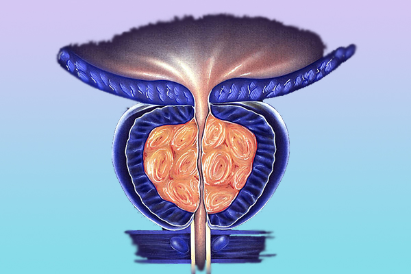 Co nhỏ tuyến tiền liệt sẽ giúp giải quyết các vấn đề của bệnh