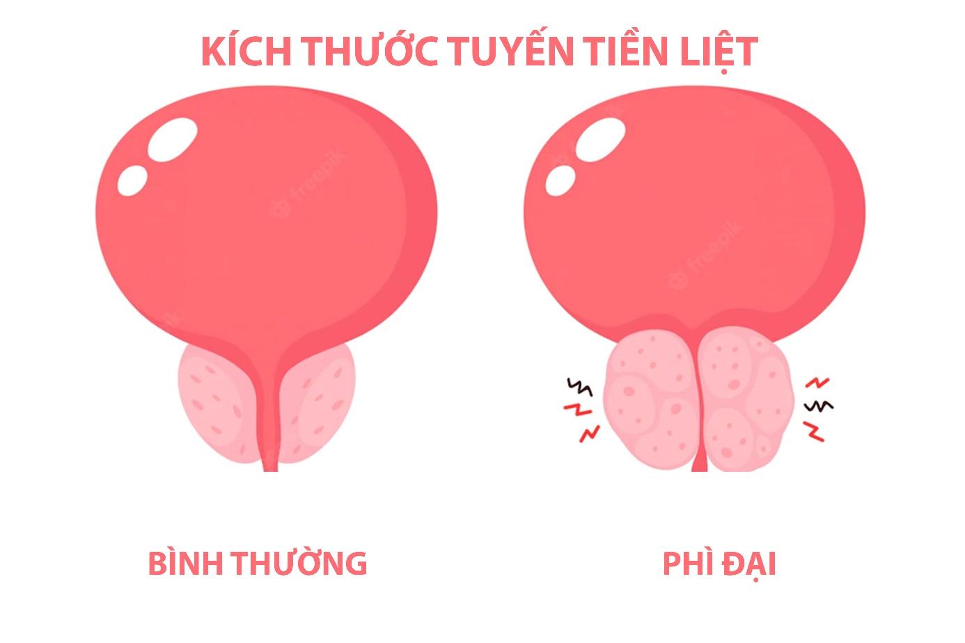 Kích thước tiền liệt tuyến bình thường là bao nhiêu, khi bị phì đại là bao nhiêu?