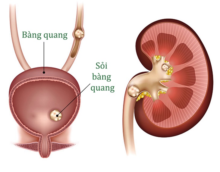 Người bệnh có thể gặp phải sỏi thận, sỏi bàng quang