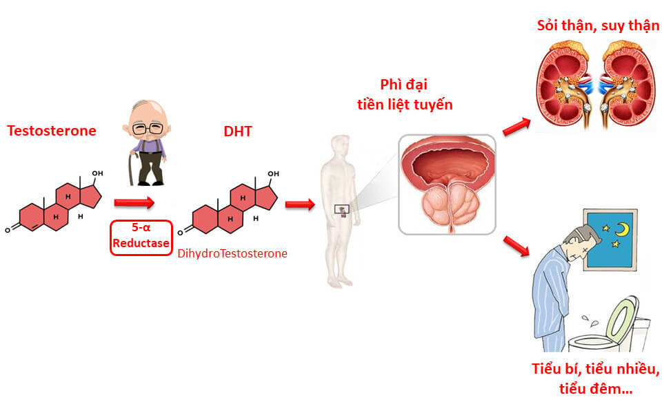 Cơ chế gây bệnh phì đại tuyến tiền liệt