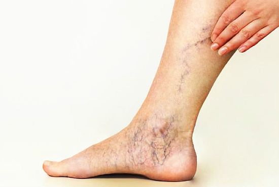 Kết quả hình ảnh cho Varicose veins