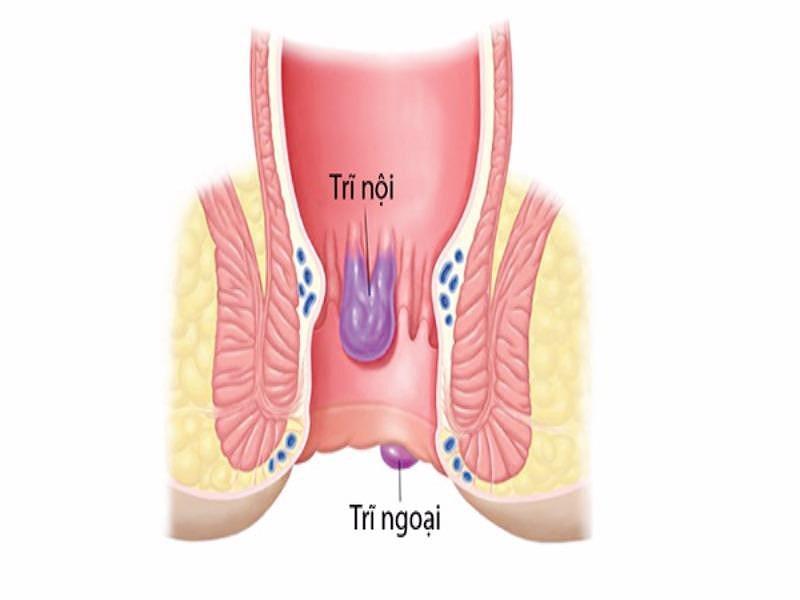 Trĩ nội và trĩ ngoại