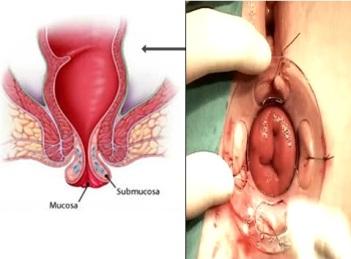 Biến chứng của bệnh trĩ