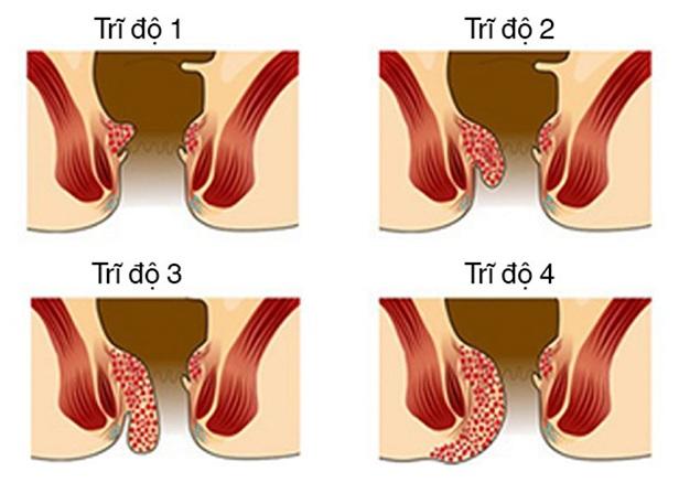 Các cấp độ bệnh trĩ nội