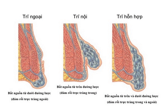 Các loại bệnh trĩ