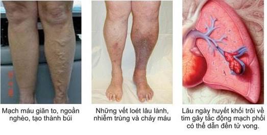 Suy giãn tĩnh mạch có nguy hiểm không?