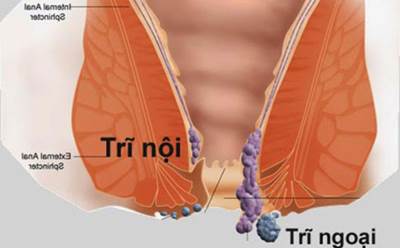 Những suy nghĩ sai lầm về bệnh trĩ, người bệnh hết sức lưu ý!