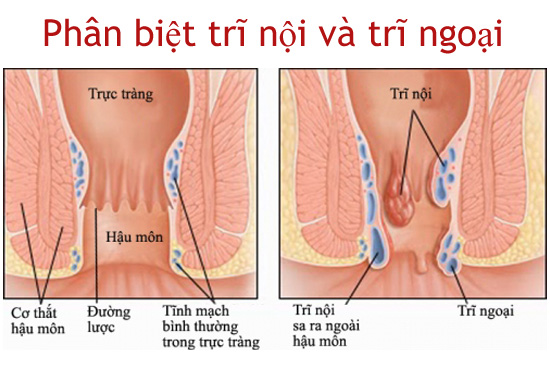 Phân biệt trĩ nội và trĩ ngoại