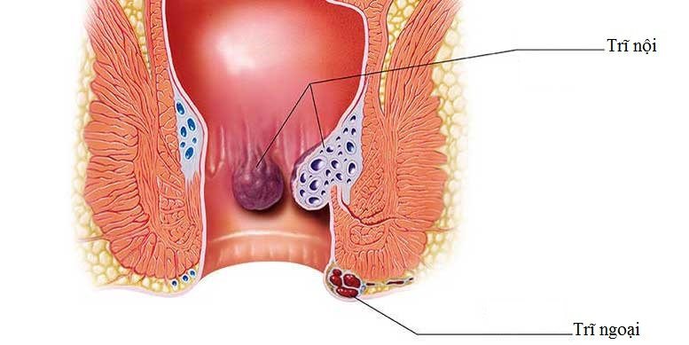 Bệnh trĩ là gì?